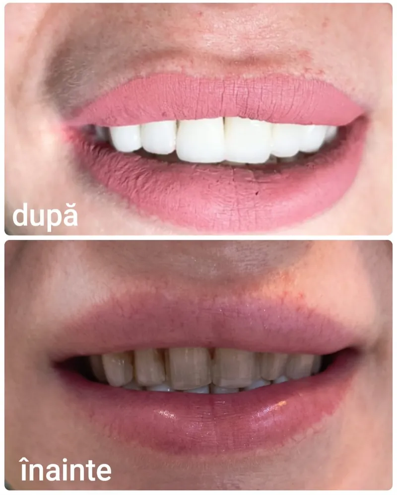 Caz clinic: fotografii înainte și după tratament