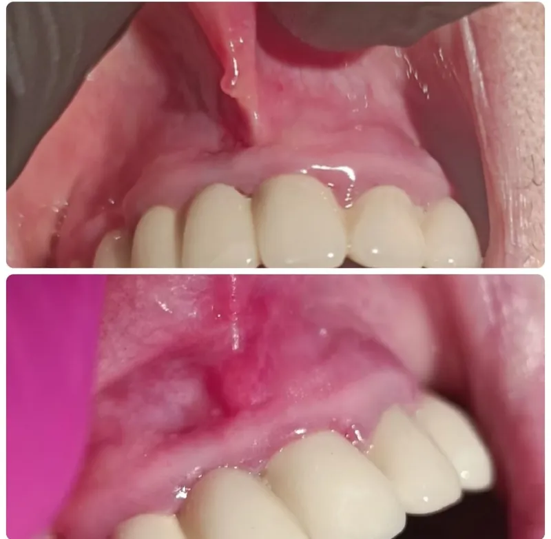 Frenectomie cu laser: înainte și după