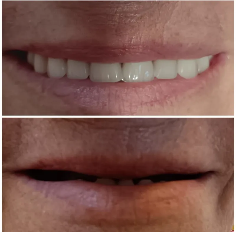 Caz de protetică dentară: înainte și după