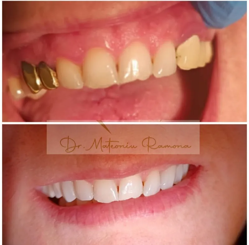 Caz de protetică dentară: înainte și după, cu lucrare nouă