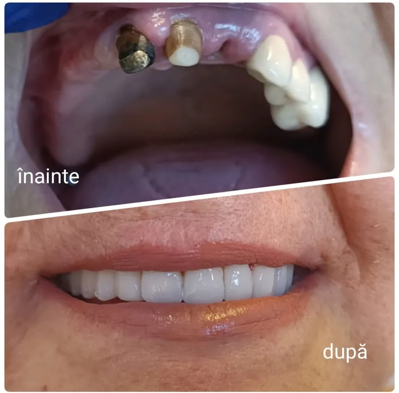 Caz de protetică dentară: înainte și după