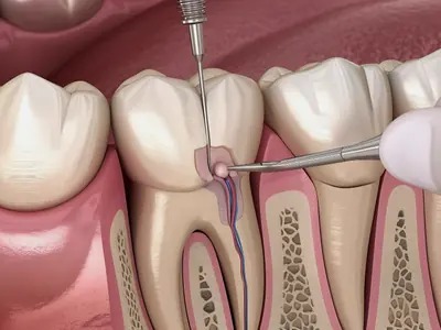 Endodonție: imagine ilustrativă